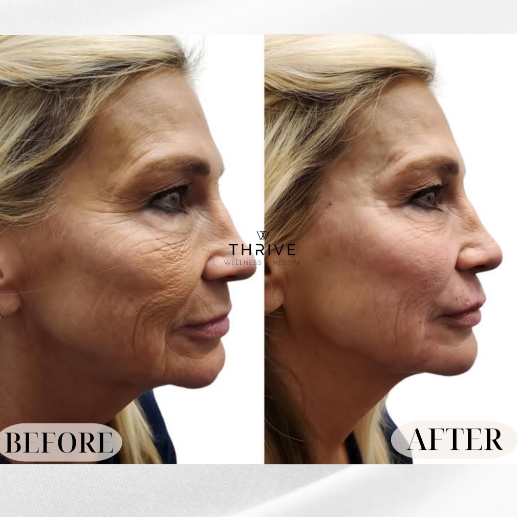 Full face rejuvenation before and after at Thrive Wellness