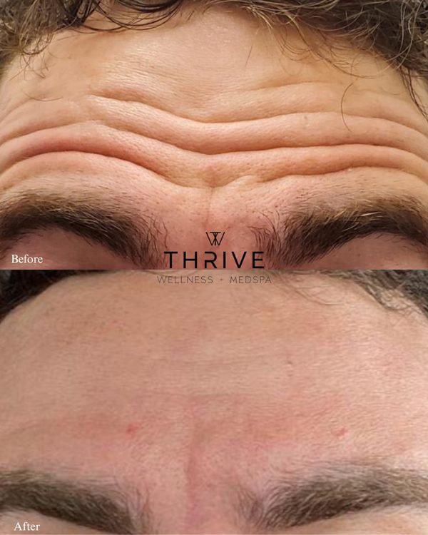 Botox before and after at Thrive Wellness