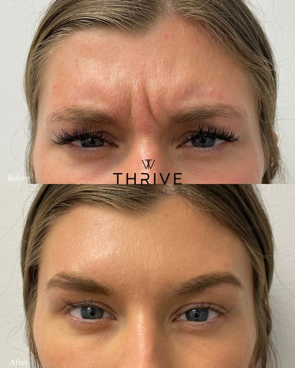 Botox before and after at Thrive Wellness