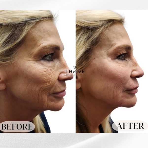 Full-face skin before and after at Thrive Wellness