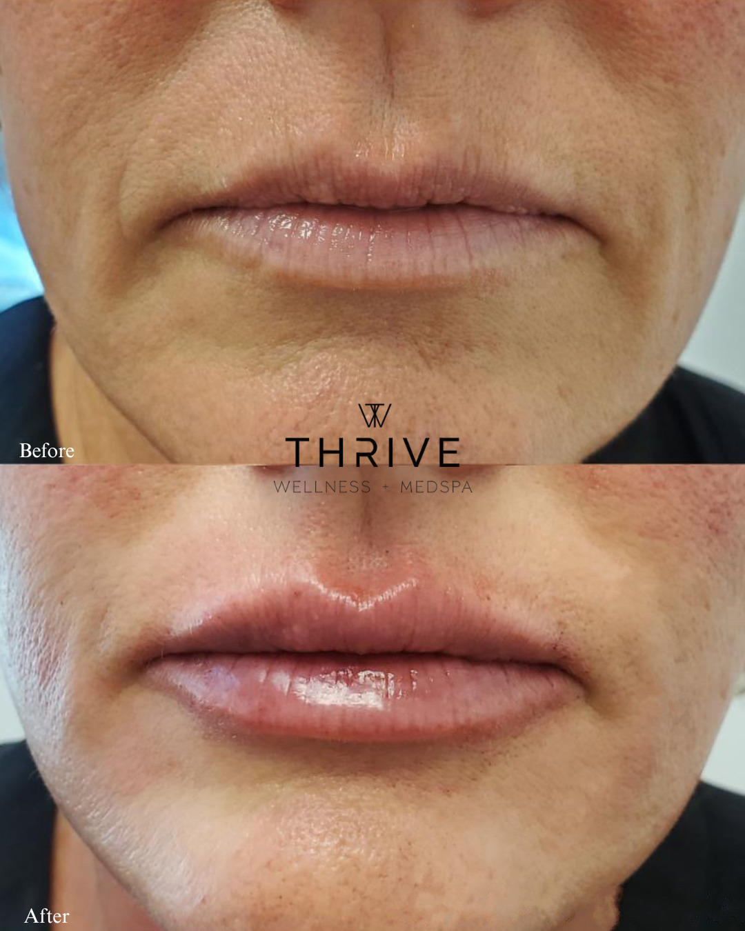 Lip filler before and after at Thrive Wellness
