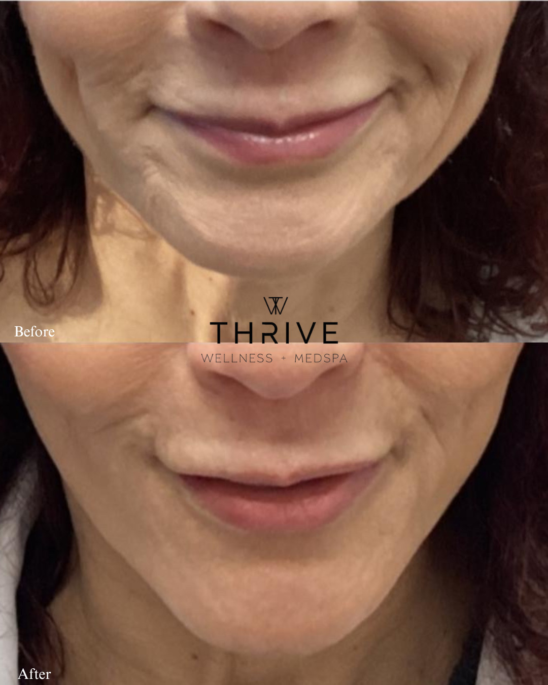 Filler before and after at Thrive Wellness